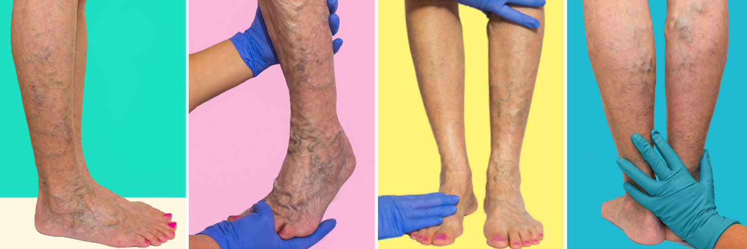 How to Prevent Varicose Veins? - WiseRxcard